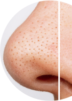 Open pores